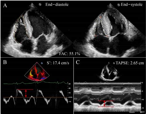 Figure From Clinical Usefulness Of Right Ventriclepulmonary Artery