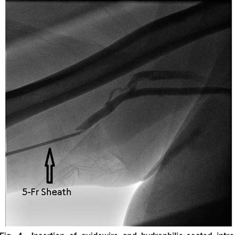 Figure 1 From VALVULAR AND STRUCTURAL HEART DISEASES Case Reports A