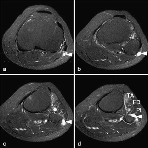 Mr Imaging Of Common Peroneal Nerve Neuropathy In A Patient With Foot Download Scientific