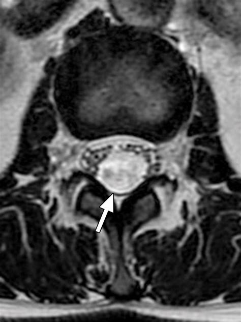 Intradural Extramedullary Spinal Neoplasms Radiologic Pathologic