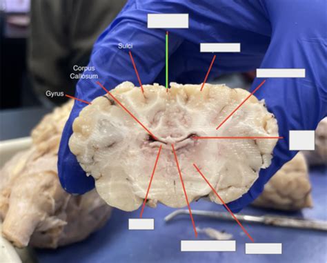 Sheep Brain W O Dura Coronal Dissection Lab Exam Flashcards Quizlet