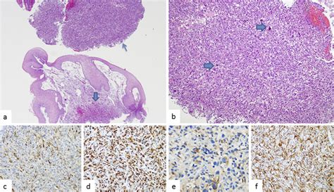 Two Endoscopic Biopsies One From The Ulcerated Tumor Thin Arrow And