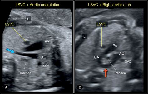 1 Aortic Coarctation Left Sided Svc 2 Right Sided Aortic Arch With Left Ductus Arteriosus U