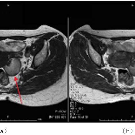 (a): Magnetic resonance imaging (MRI) scans (T1-weighted image)... | Download Scientific Diagram