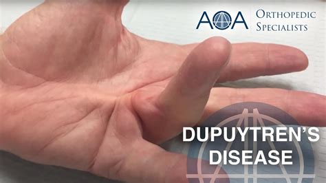 AOA Orthopedic Specialists Dupuytren S Contracture YouTube