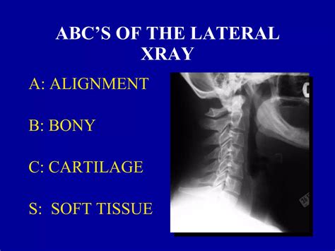 Clearing C Spine Nexus Criteria 3