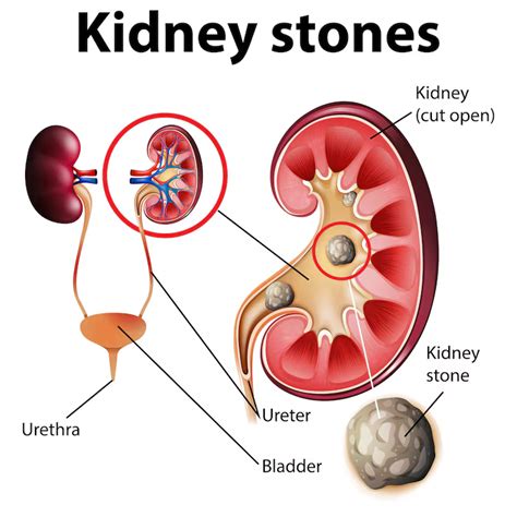 Kidney Stones Renal Calculi Nuffield Kidney And Dialysis Nuffield