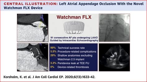 The Watchman Flx Device First European Experience And Feasibility Of