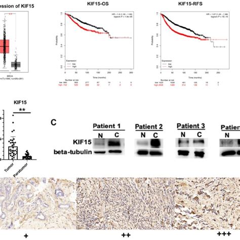 Kif Is Highly Expressed In Breast Cancer Tissues A Tcga Data