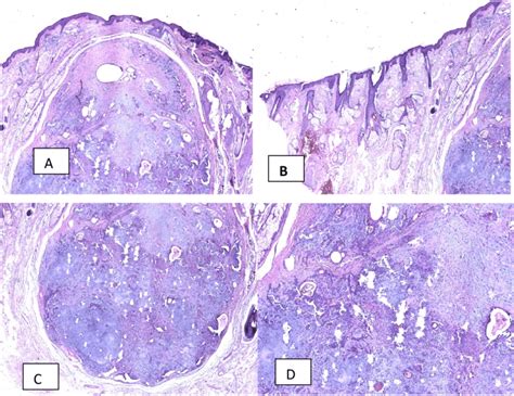 Histopathology Of The Cutaneous Pleomorphic Adenoma A The Lesion With Download Scientific