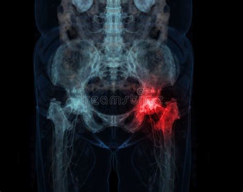 Ct Scan Of Pelvic Bone And Hip Joint 3d Rendering For Diagnosis