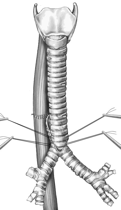 Slide Tracheoplasty In Infant With Congenital Tracheal Stenosis And Tracheomalacia After