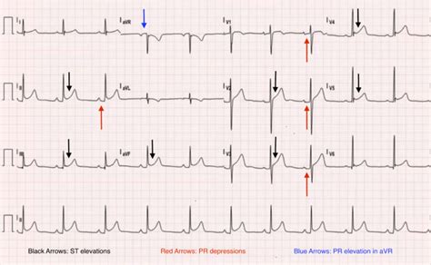 Annotated Pericarditis Ecg Jetem 2016 Jetem