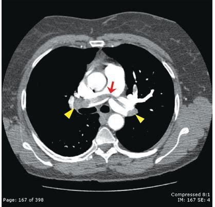 Pulmonary Embolism on CT Angiography | AccessMedicine Network