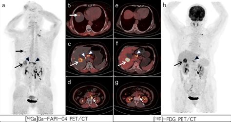 Frontiers Comparison Of Diagnostic Efficacy Of 68Ga Ga FAPI 04 And