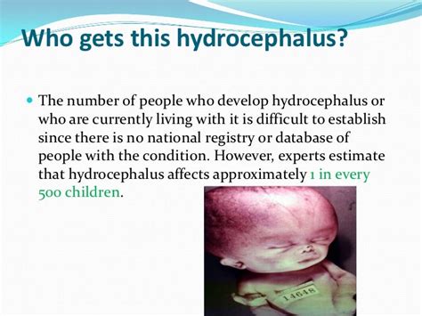 Hydrocephalus