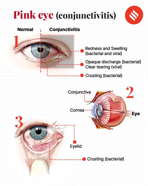 Conjunctivitis Unmasked Understanding The Common Eye Flu