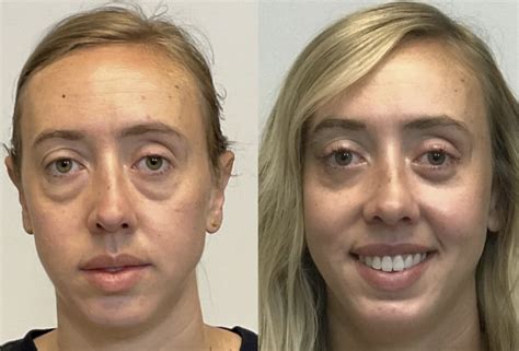 What Is Blepharoplasty Procedure Plastic Surgery