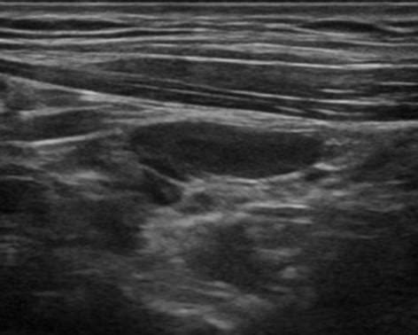 Head and Neck | 4.1 Thyroid gland : Case 4.1.4 Thyroiditis and diffuse ...