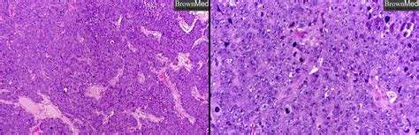 Squamous Cell Carcinoma Pathology Residency And Fellowship Program