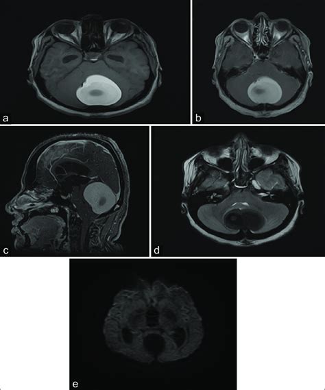 A T1 Weighted Sequence B T1 Weighted Post Contrast Axial Sequence