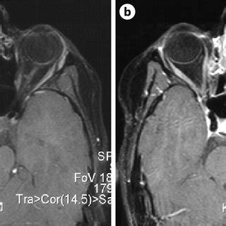 A B Axial Mri Scans A B Months After Surgery Depicting Total