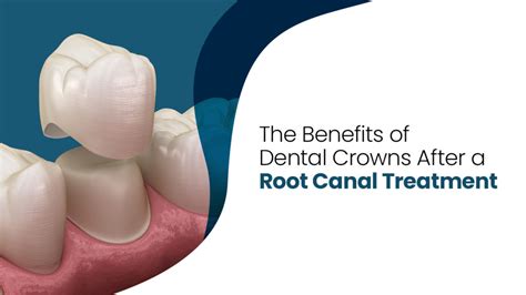 5 Benefits From Dental Crown After Root Canal Springvale Blog