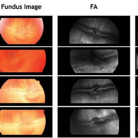 Fundus Imaging Fluorescein Angiography Fa And Optical Coherence