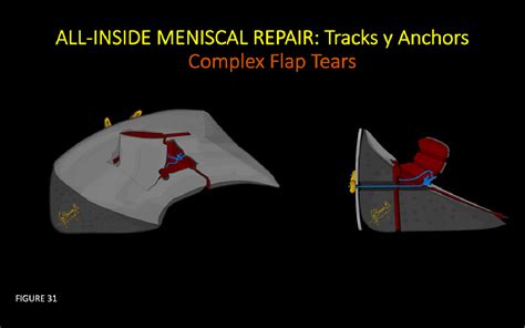 Figure From All Inside Meniscal Repair On Mri Suture Tracks And