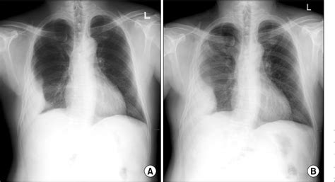 Figure From A Case Of Spontaneous Chronic Expanding Hematoma In The