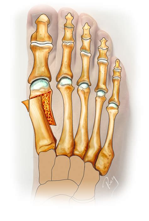 Hallux Valgus Op Ration Traitement Et Origine Centre Du Pied