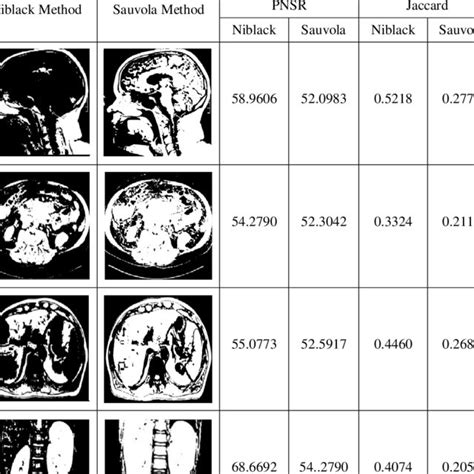 Fuzzy Entropy With The Level Set Segmentation Of Ultrasound Breast