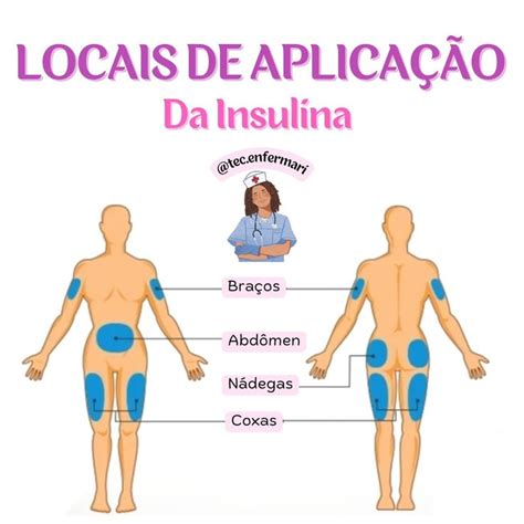 Locais de Aplicação da Insulina Material de enfermagem Tecnico em