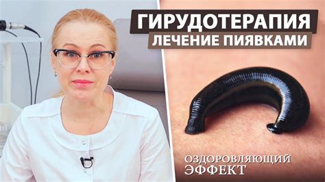 Гирудотерапия - особенности, показания и противопоказания