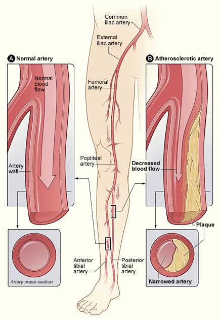 Peripheral Arterial Disease Treatment In Cork