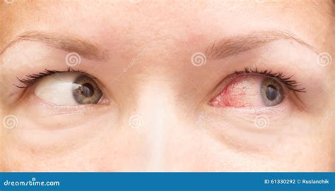 Healthy And Irritated Eye Stock Photo - Image: 61330292