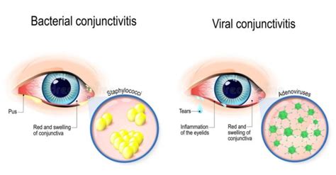 My 22 Day Battle With Viral Conjunctivitis And How To Avoid Pink Eye