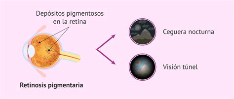 Visi N Con La Retinosis Pigmentaria