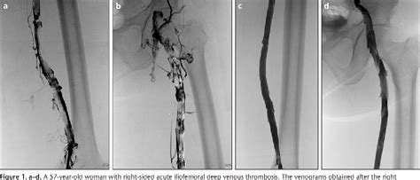 Figure 1 From Endovascular Treatment Of Acute And Subacute Iliofemoral Deep Venous Thrombosis By