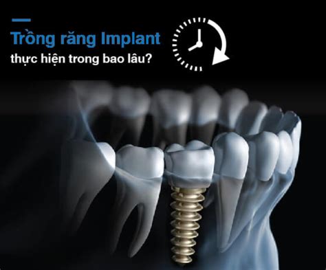 Tr Ng R Ng Implant M T Th I Gian Bao L U V Ph Thu C Y U T N O Ngh G