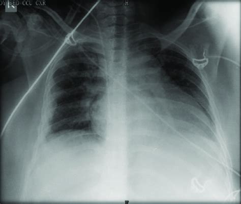 Chest X-Ray-cardiomegaly | Download Scientific Diagram