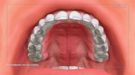 Oral Cancer Screening Lifetime Dentistry