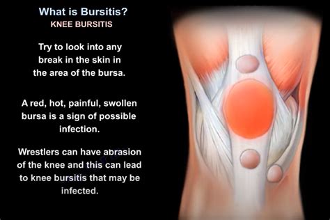 3 Bursitis Knee Hip Elbow Shoulder 1 1 Dr Nabil Ebraheim S Blog