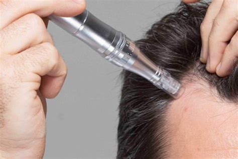 Microneedling for hair loss - myhair