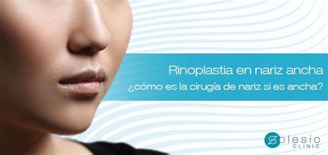 Rinoplastia En Nariz Ancha Corrección De Nariz Ancha O Globulosa