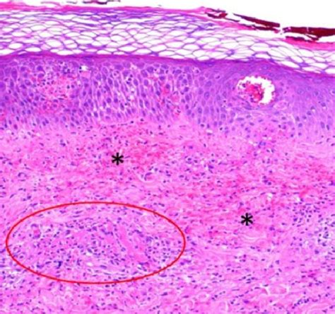 Superficial And Mid Dermal Perivascular And Interstitial Mixed Download Scientific Diagram