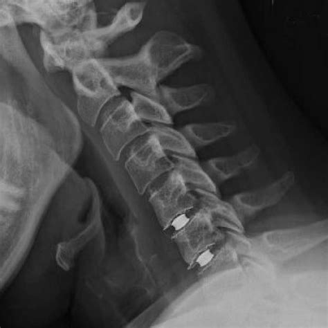 Cervical Artificial Discs Jeffrey A Goldstein Md