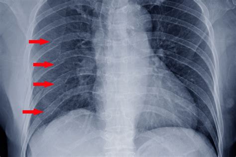 Neumark Treatment for Nonunion Rib Fractures with Internal Rib Fixation