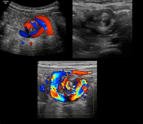 Intestinal Malrotation Mid Gut Volvulus Sonographic Tendencies