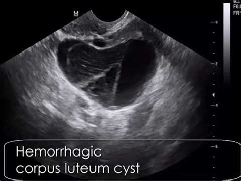 Case 609 Hemorrhagic Corpus Luteum Cyst CLC YouTube